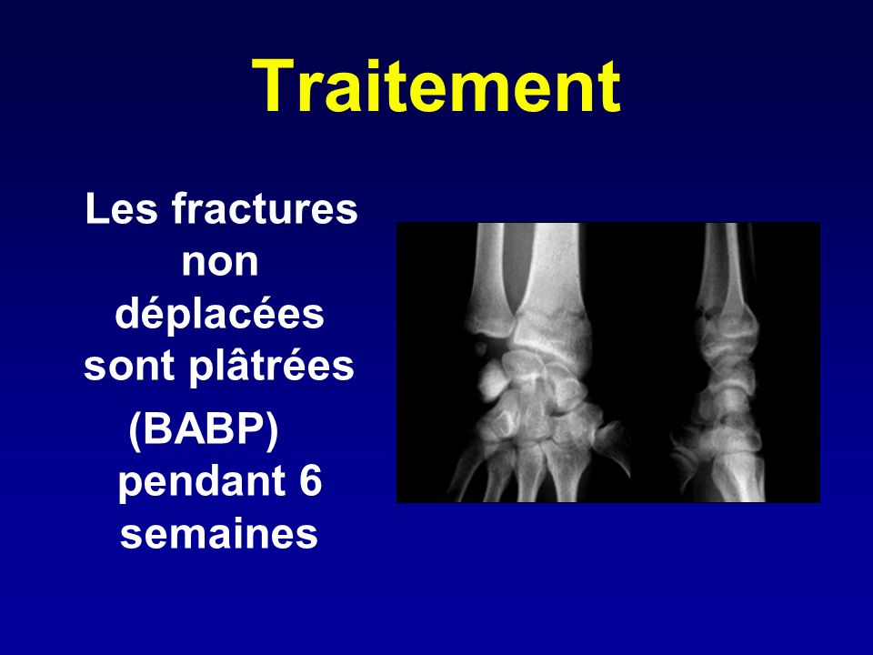 Les fractures non déplacées sont plâtrées (BABP) pendant 6 semaines