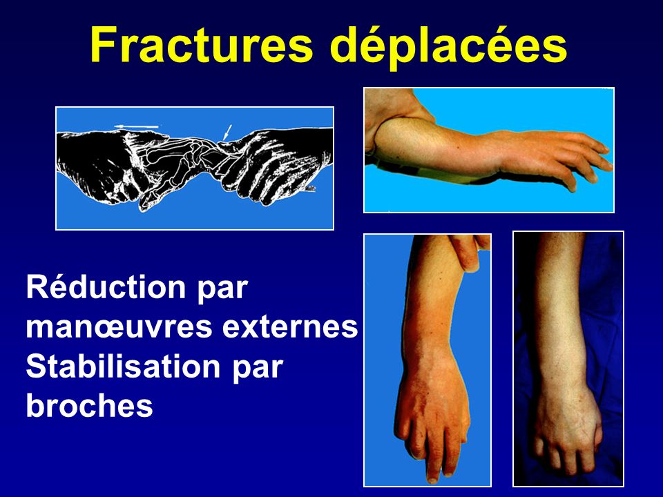 Fractures déplacées Réduction par manœuvres externes Stabilisation par