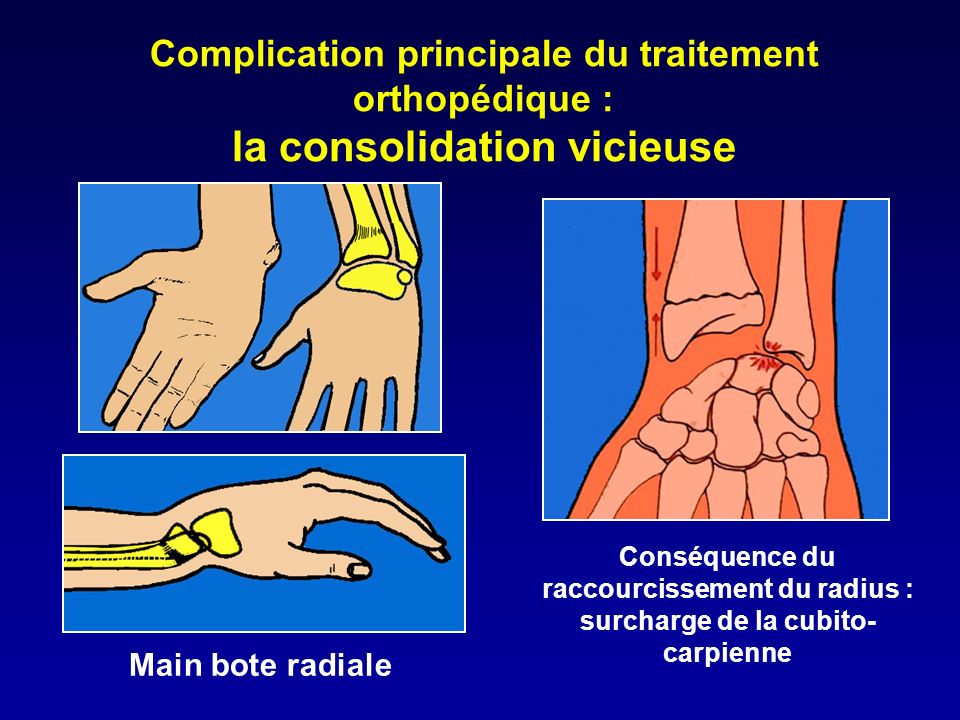 Complication principale du traitement orthopédique : la consolidation vicieuse
