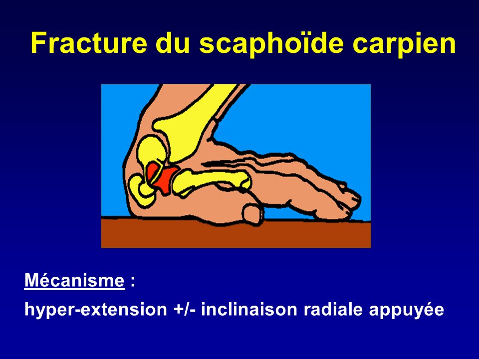 Fracture du scaphoïde carpien