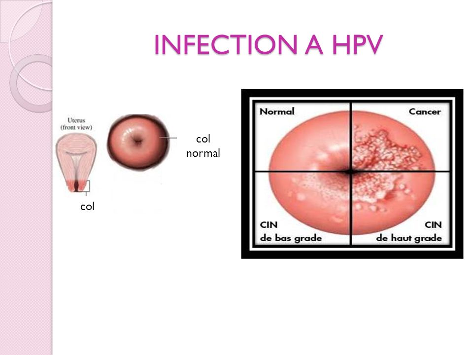 INFECTION A HPV col normal col
