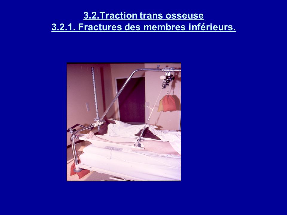 3.2.Traction trans osseuse Fractures des membres inférieurs.