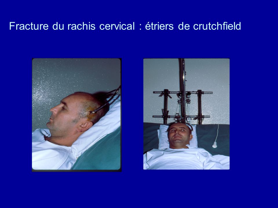 Fracture du rachis cervical : étriers de crutchfield