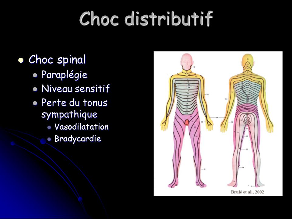 Choc distributif Choc spinal Paraplégie Niveau sensitif