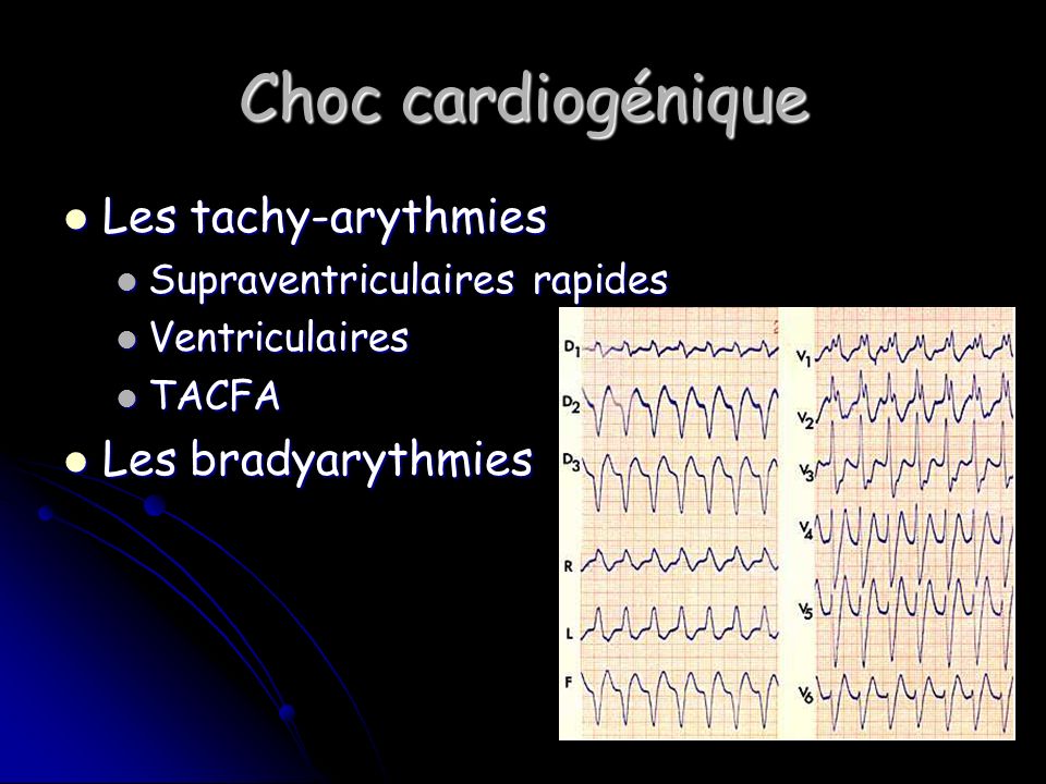 Choc cardiogénique Les tachy-arythmies Les bradyarythmies