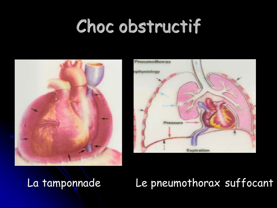 Choc obstructif La tamponnade Le pneumothorax suffocant