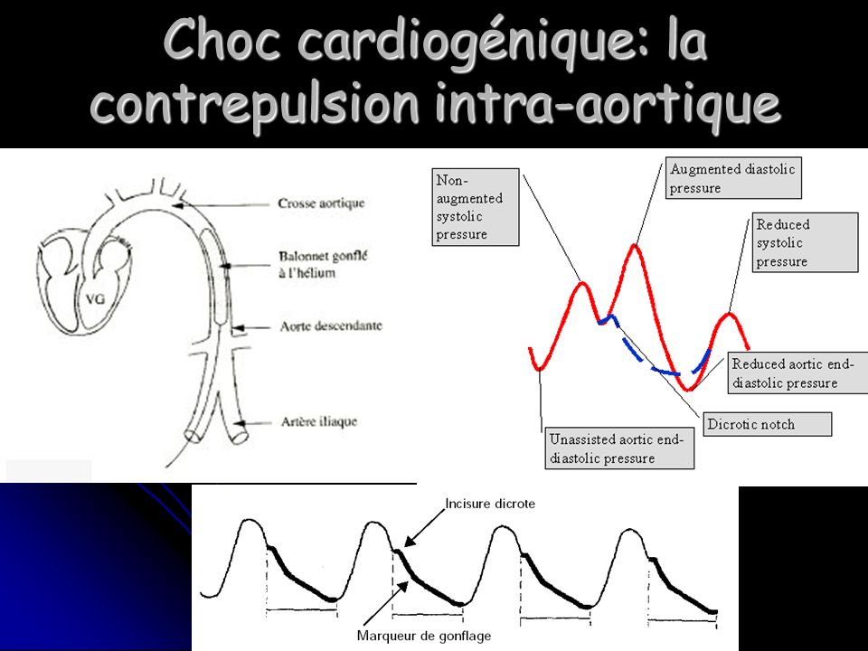 Choc cardiogénique: la contrepulsion intra-aortique