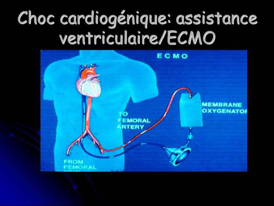 Choc cardiogénique: assistance ventriculaire/ECMO