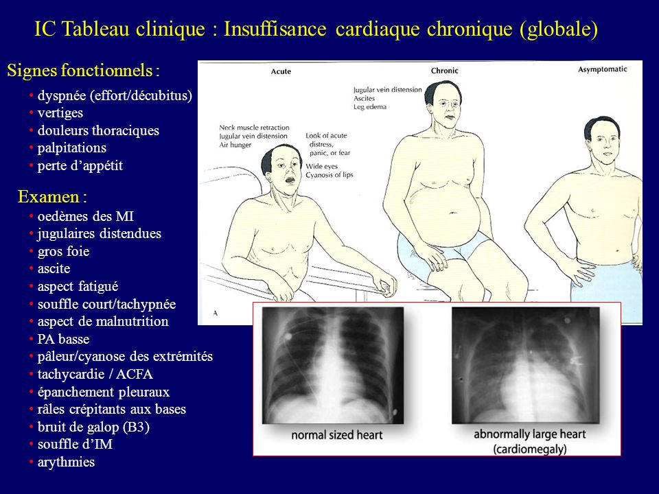 IC Tableau clinique : Insuffisance cardiaque chronique (globale)