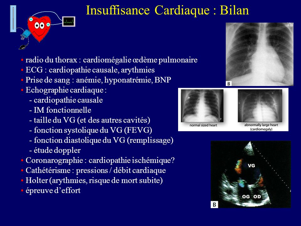 Insuffisance Cardiaque : Bilan