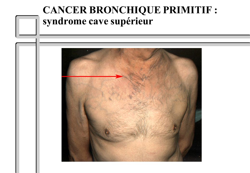 CANCER BRONCHIQUE PRIMITIF : syndrome cave supérieur