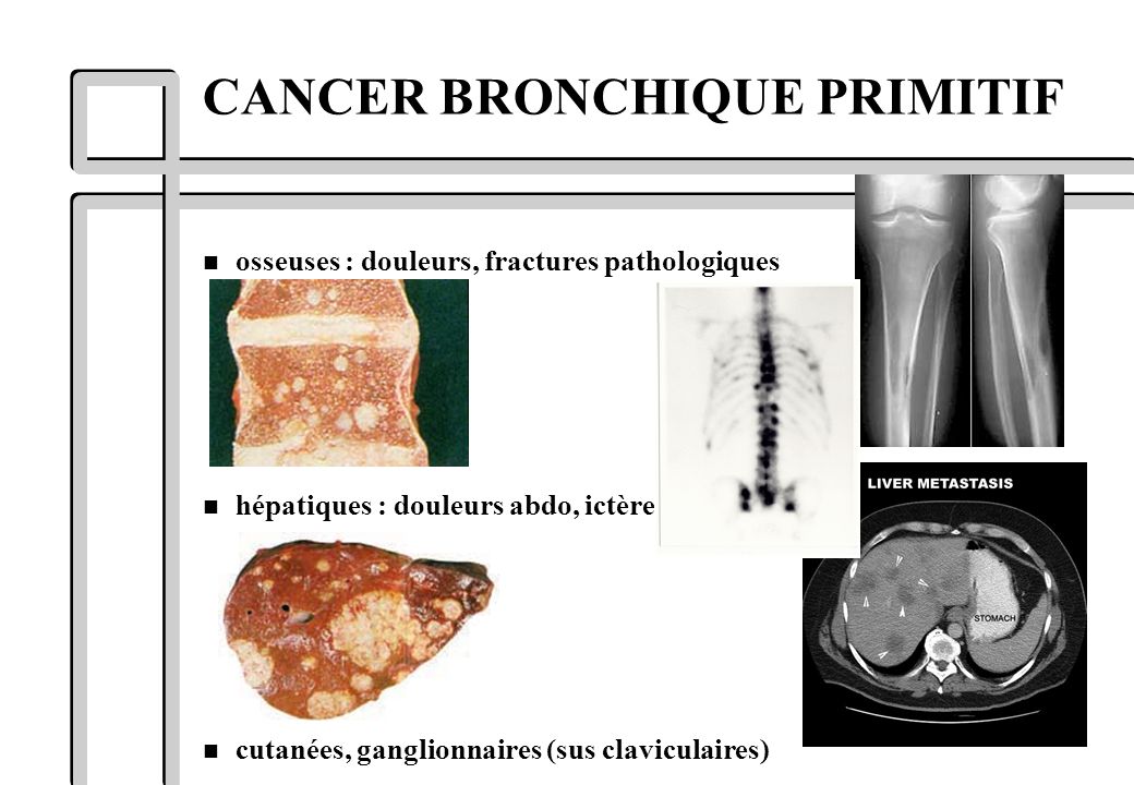 CANCER BRONCHIQUE PRIMITIF