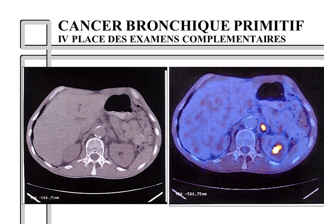 CANCER BRONCHIQUE PRIMITIF IV PLACE DES EXAMENS COMPLEMENTAIRES