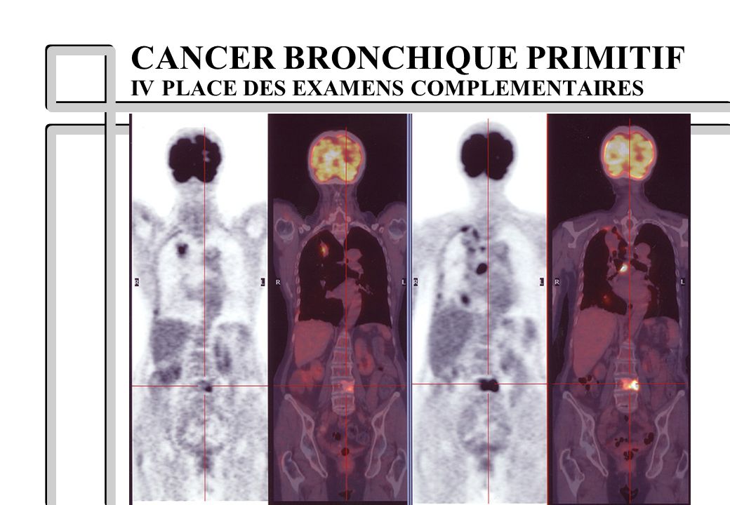 CANCER BRONCHIQUE PRIMITIF IV PLACE DES EXAMENS COMPLEMENTAIRES