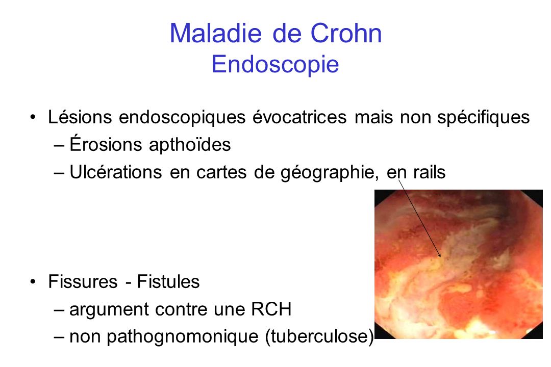 Maladie de Crohn Endoscopie