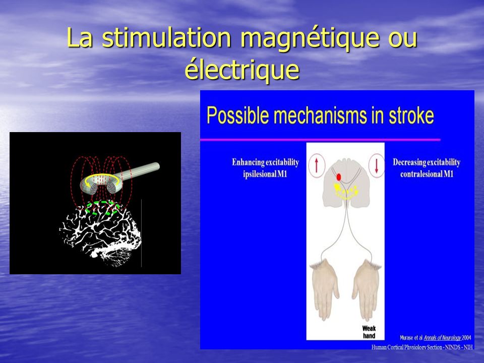 La stimulation magnétique ou électrique