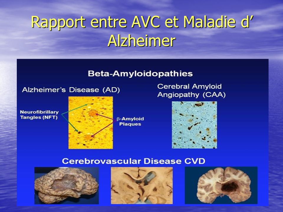 Rapport entre AVC et Maladie d’ Alzheimer