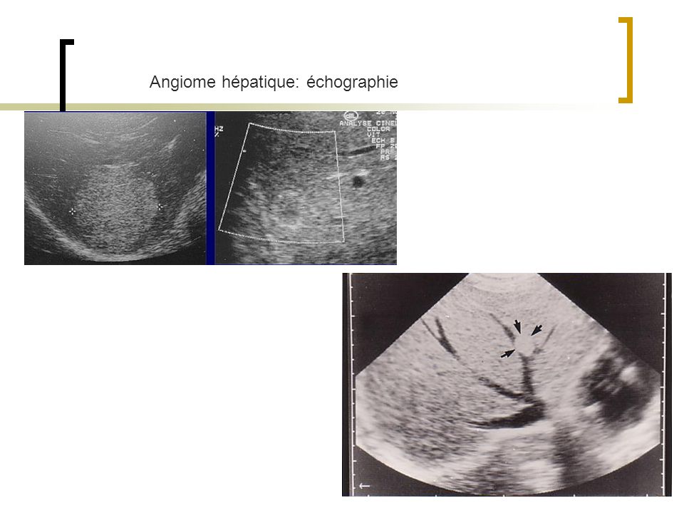 Angiome hépatique: échographie
