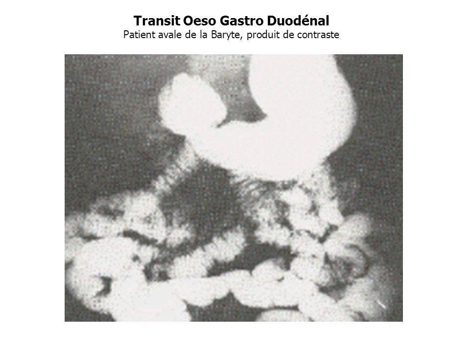 Transit Oeso Gastro Duodénal Patient avale de la Baryte, produit de contraste