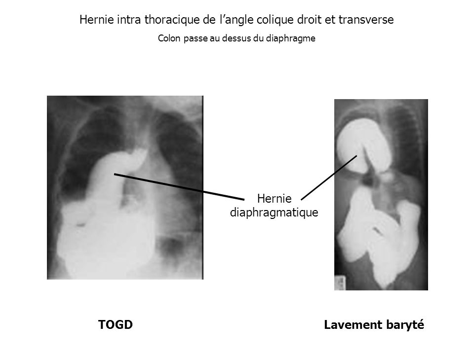 Hernie intra thoracique de l’angle colique droit et transverse