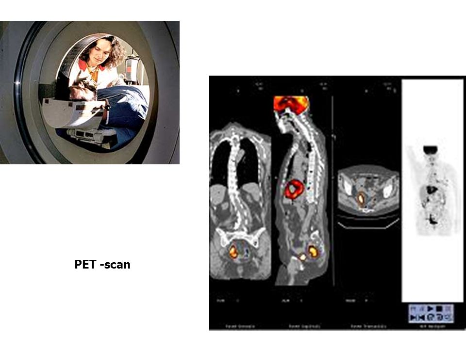 PET -scan