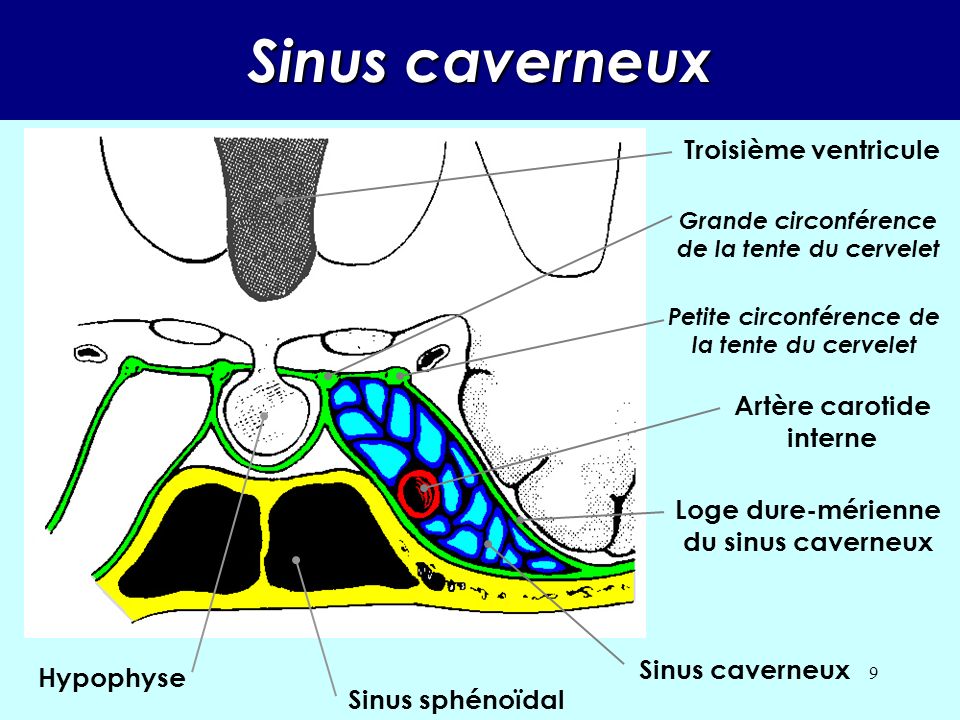 Sinus caverneux Troisième ventricule Artère carotide interne