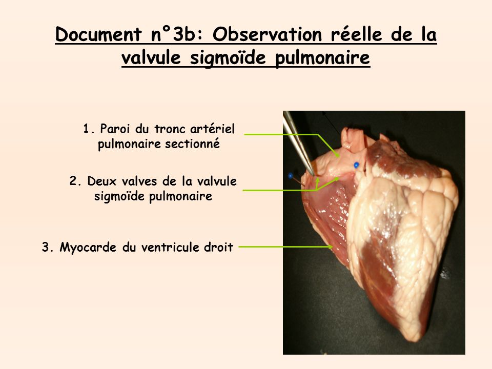 Document n°3b: Observation réelle de la valvule sigmoïde pulmonaire