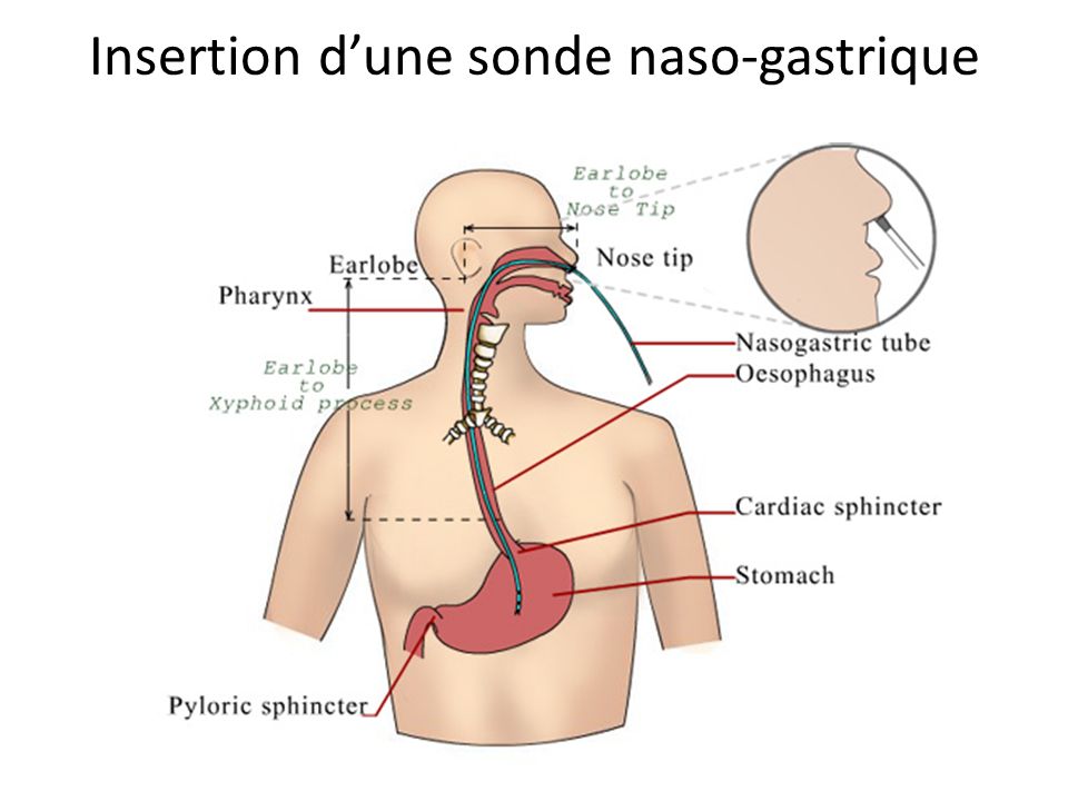Insertion d’une sonde naso-gastrique