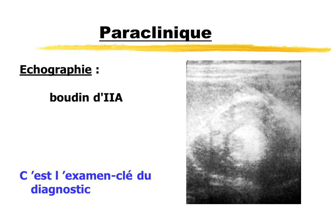 Paraclinique Echographie : boudin d IIA