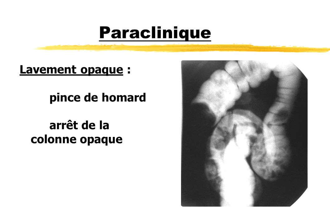 Paraclinique Lavement opaque : pince de homard arrêt de la colonne opaque