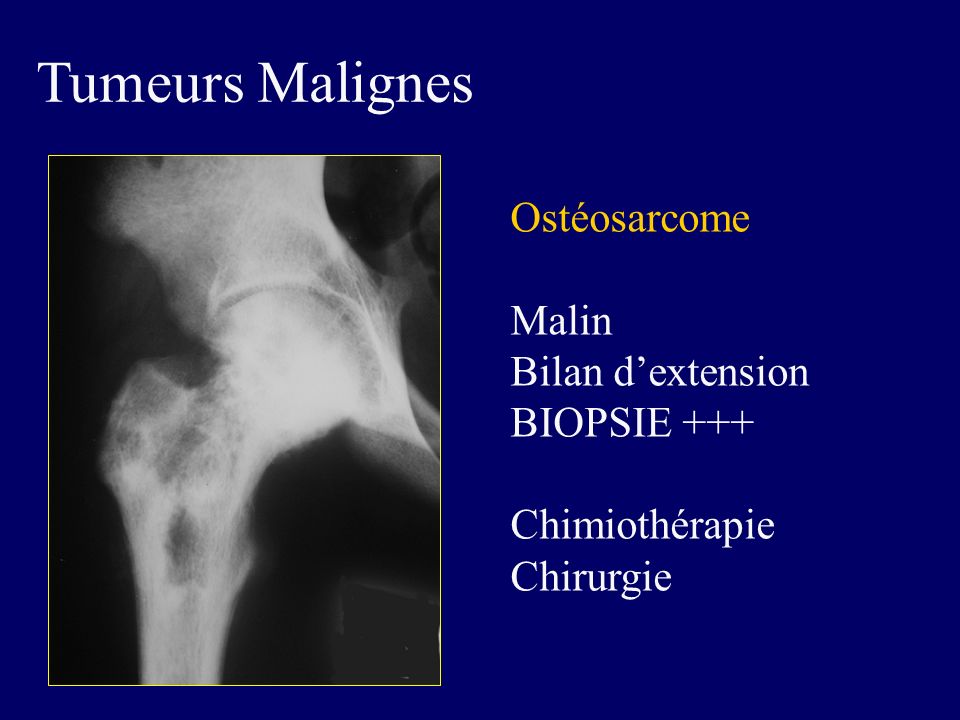 Tumeurs Malignes Ostéosarcome Malin Bilan d’extension BIOPSIE +++