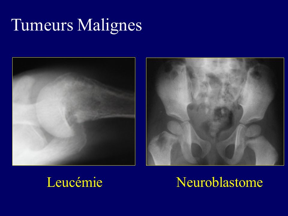 Tumeurs Malignes Leucémie Neuroblastome