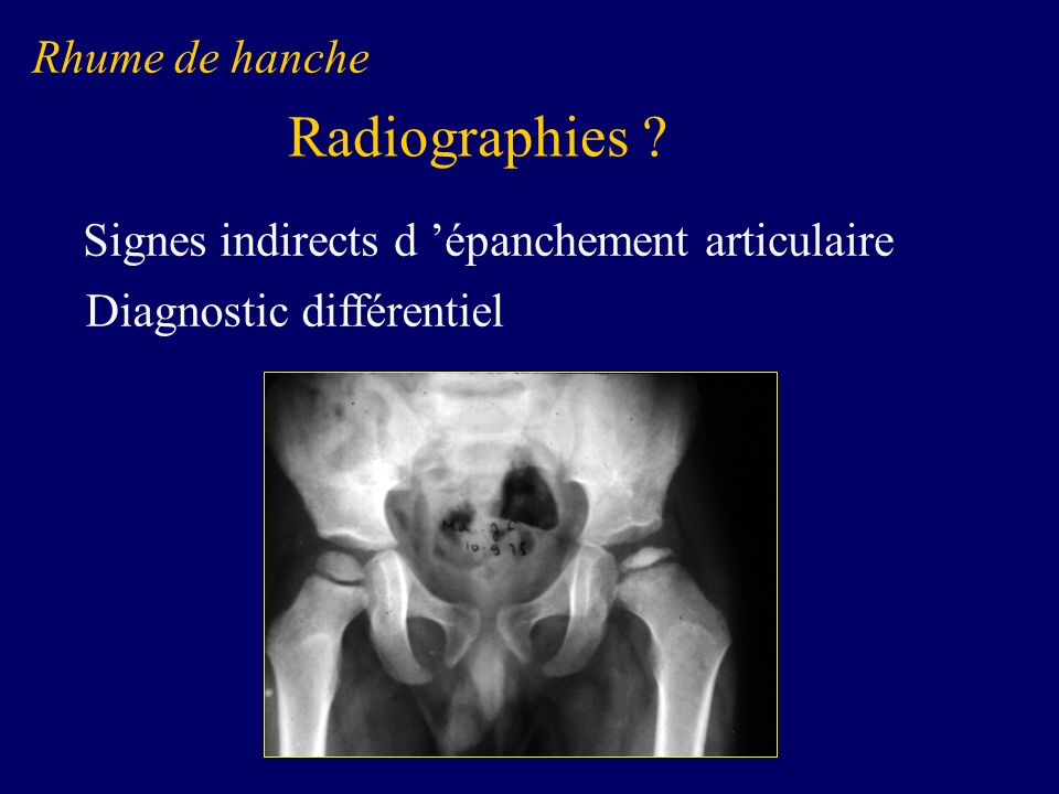 Radiographies Rhume de hanche
