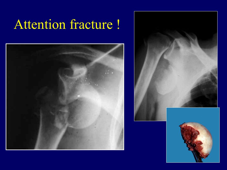 Attention fracture !