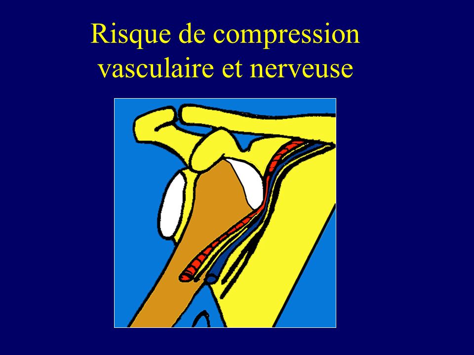 Risque de compression vasculaire et nerveuse