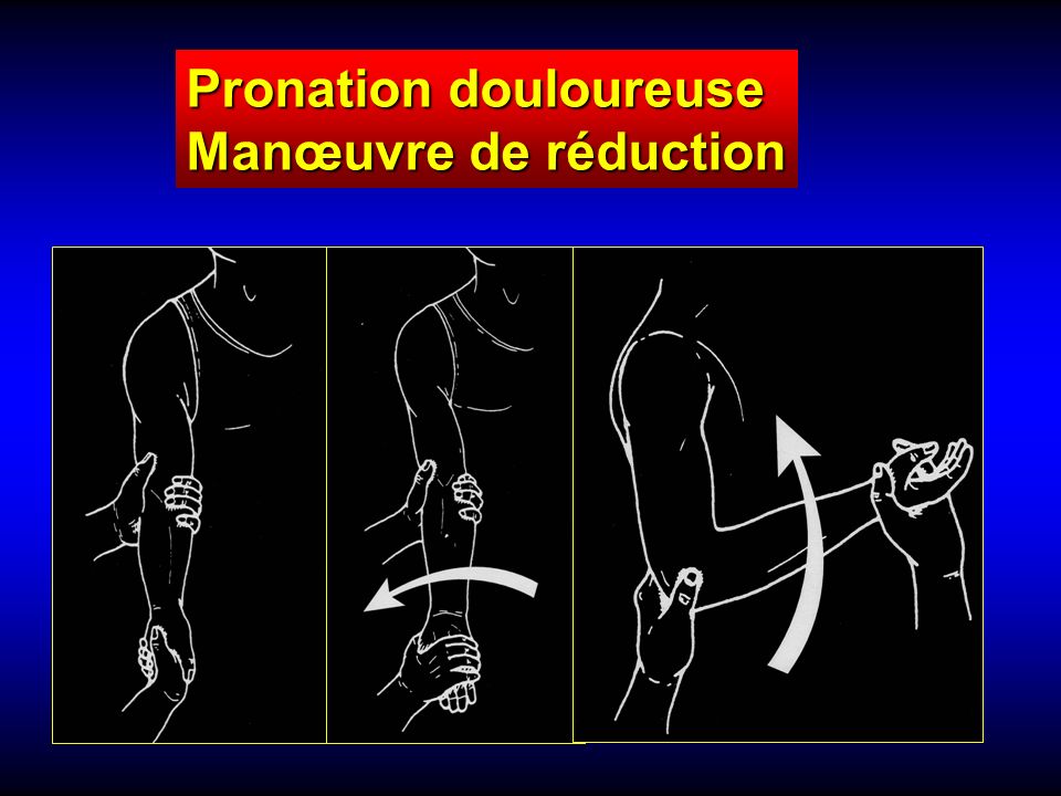 La pronation douloureuse - ppt video online télécharger