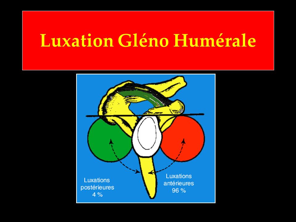 Luxation Gléno Humérale