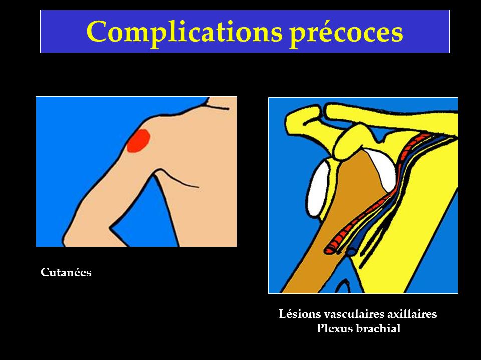 Complications précoces