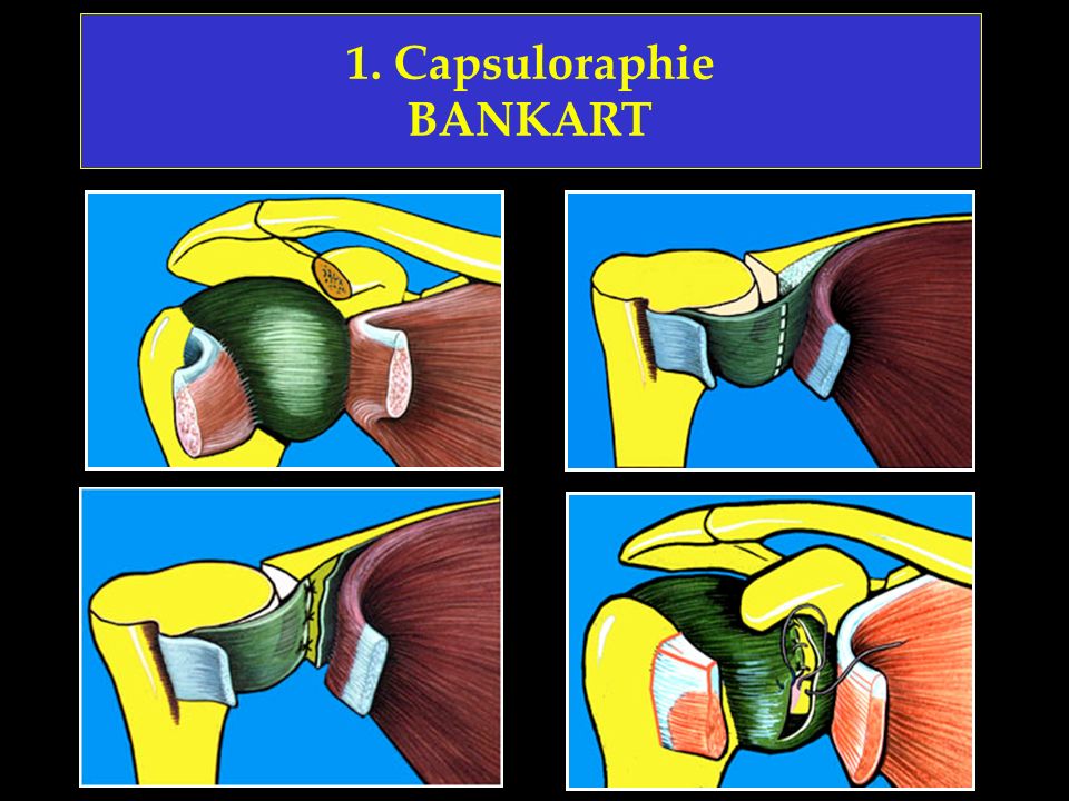 1. Capsuloraphie BANKART
