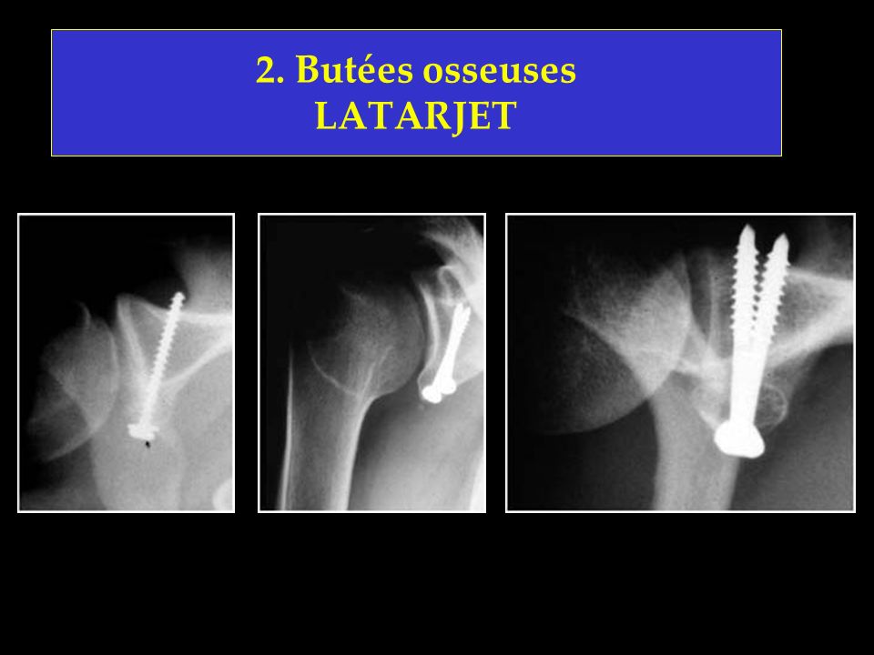 2. Butées osseuses LATARJET