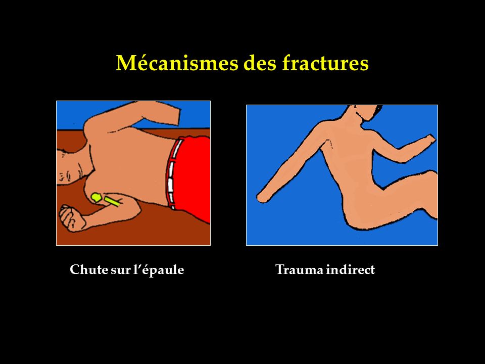 Mécanismes des fractures