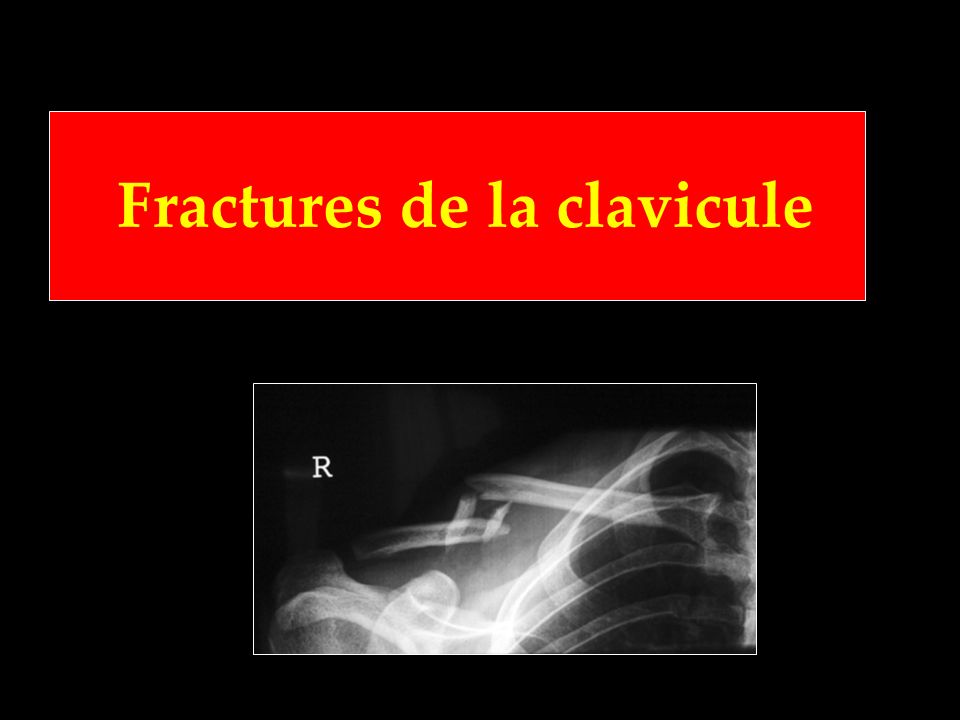 Fractures de la clavicule