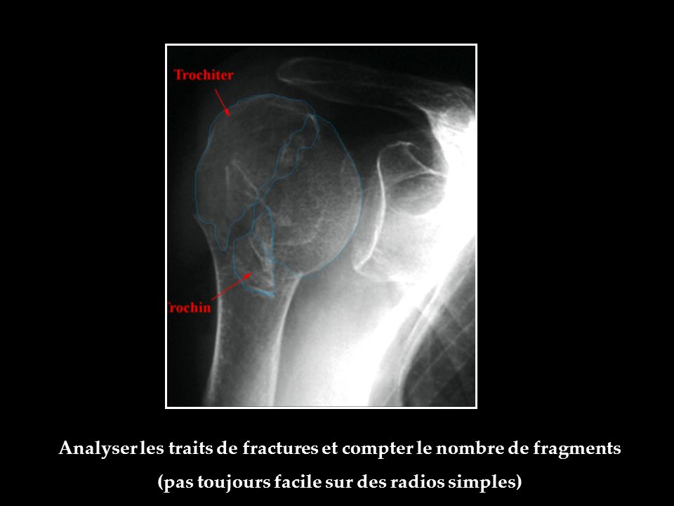 Analyser les traits de fractures et compter le nombre de fragments