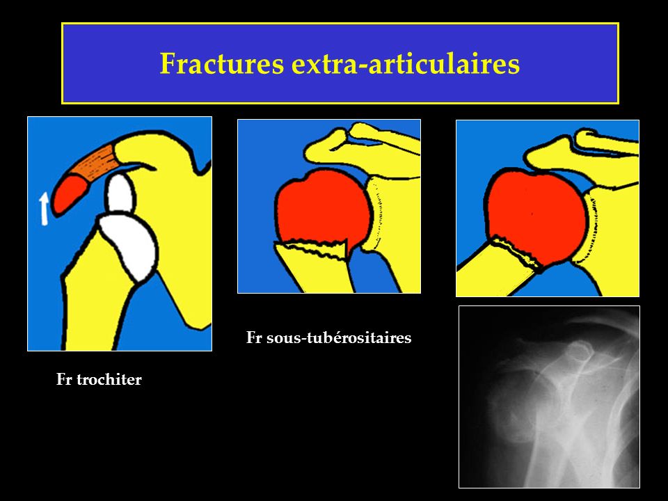 Fractures extra-articulaires