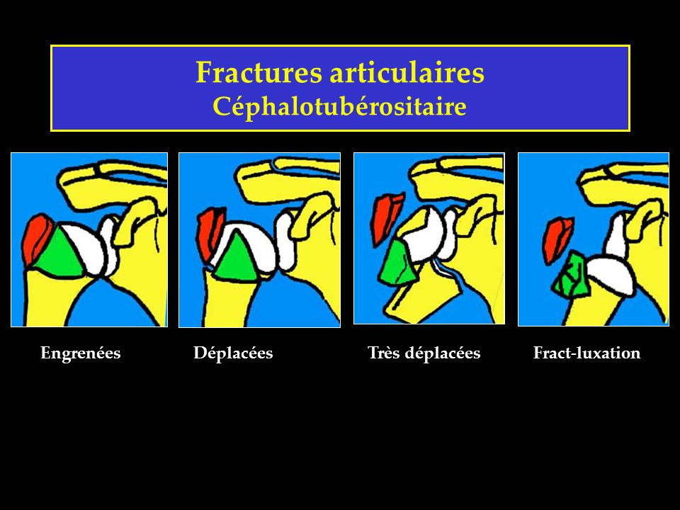 Fractures articulaires Céphalotubérositaire