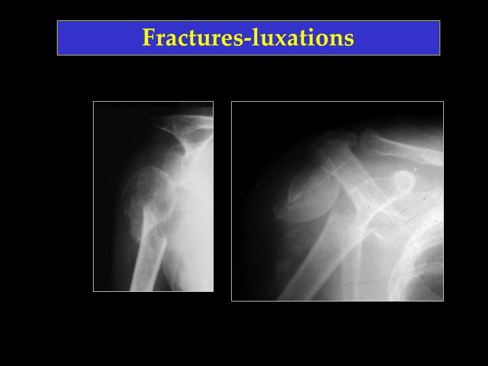Fractures-luxations