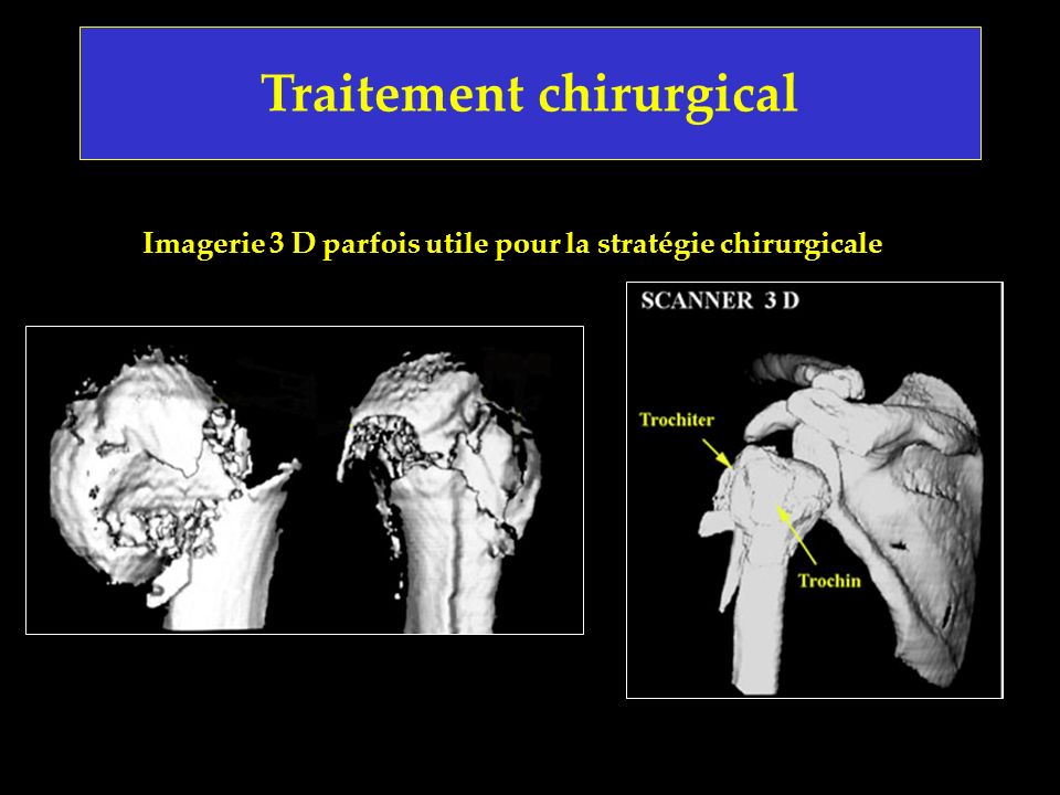 Imagerie 3 D parfois utile pour la stratégie chirurgicale
