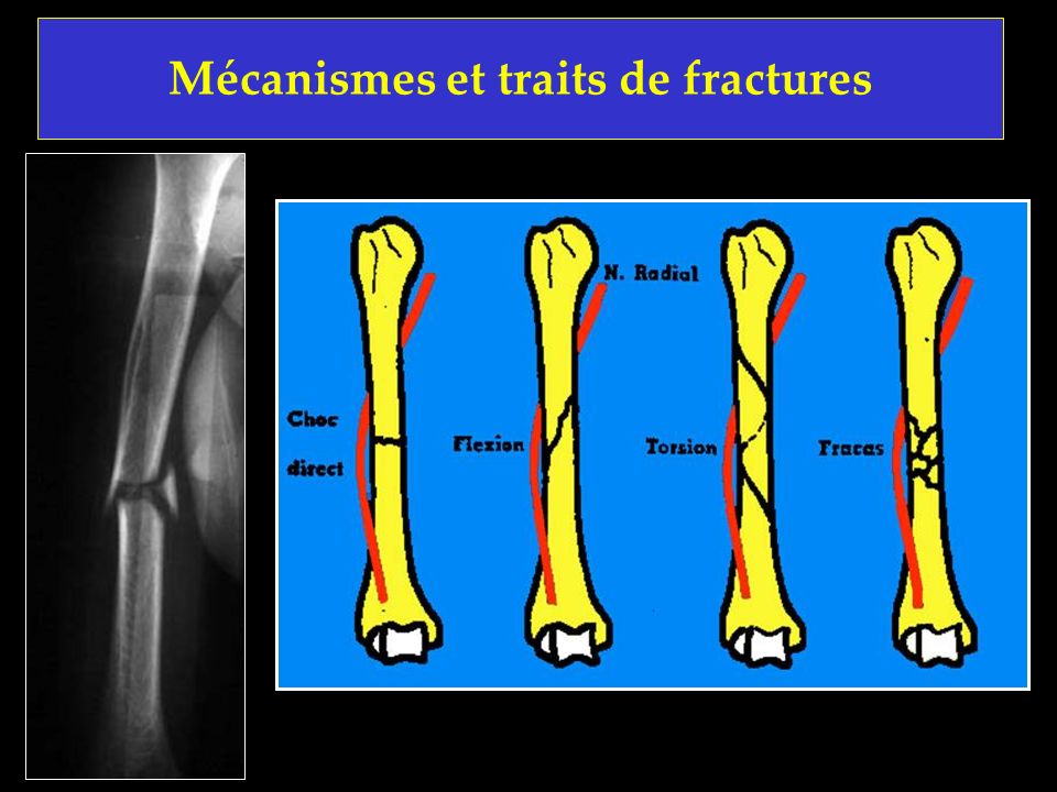 Mécanismes et traits de fractures