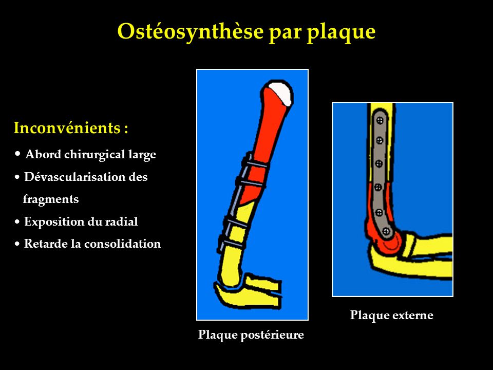 Ostéosynthèse par plaque