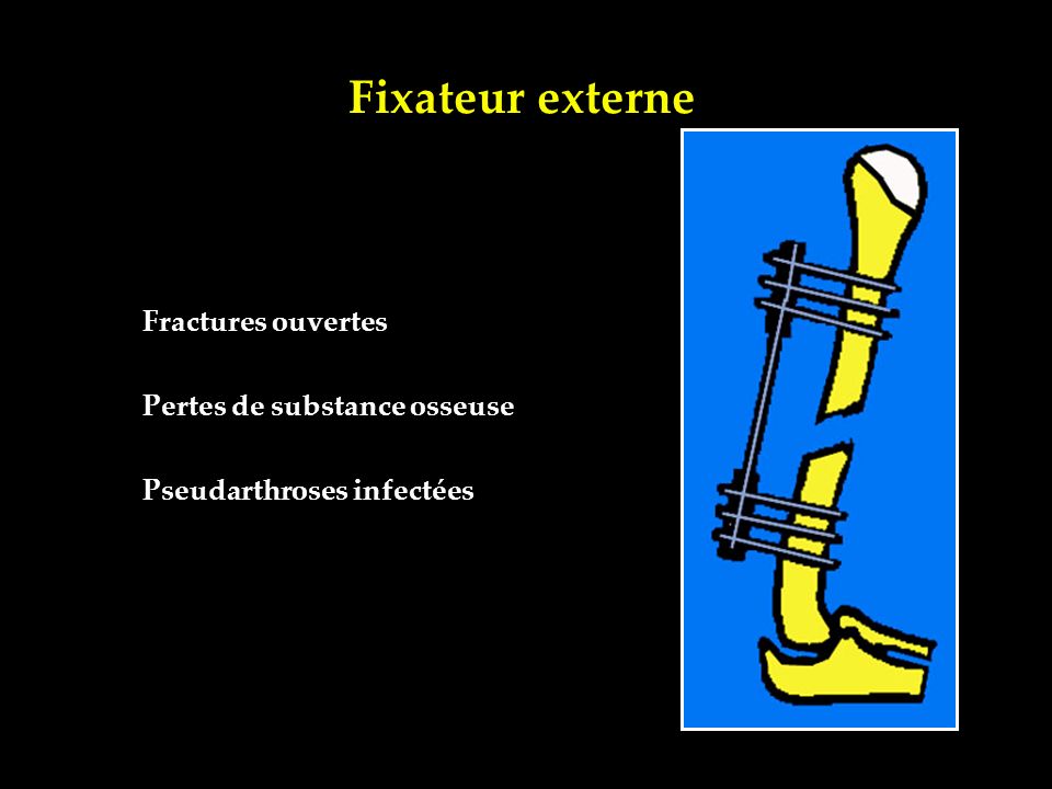 Fixateur externe Fractures ouvertes Pertes de substance osseuse
